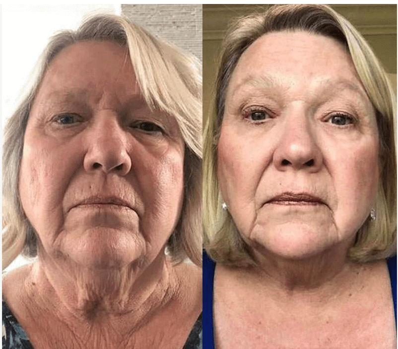 Before and after results on mature skin after consistent use of Lionelle Derma Roller.